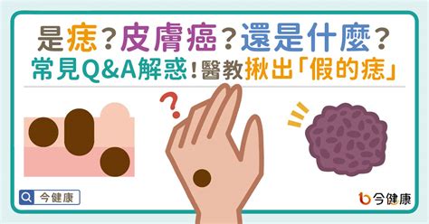 為什麼身上會有痣|是痣？皮膚癌？還是什麼？常見Q&A解惑！醫教揪出「。